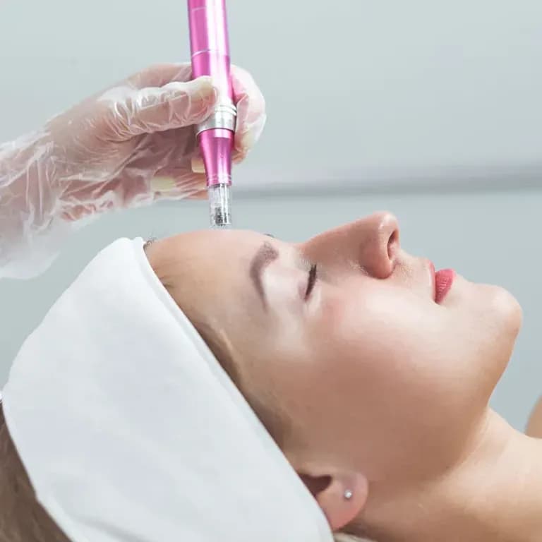 RF microneedling treatment applied to patient's face during professional aesthetic procedure